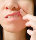 אפטה בפה: כואב אבל חולף-תמונה